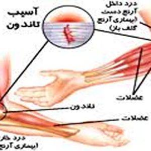 دانلود پاورپوینت با موضوع آسیب های آرنج، در قالب pptx و در 26 اسلاید، قابل ویرایش، شامل آناتومی مفصل آرنج، آسیب های ناحیه آرنج، آسیب های آرنج در افراد بالغ، آرنج تنیس بازان، علائم و تشخیص تنیس البو، گلف البو یا آرنج گلف بازان، علائم گلف البو